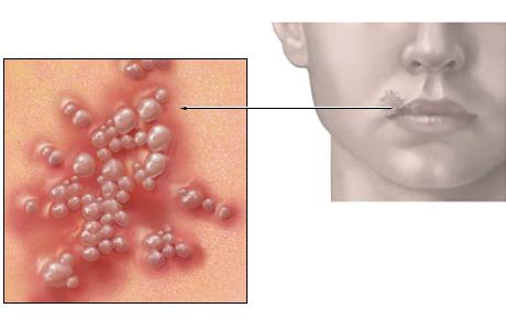 It is interesting to know what is herpes