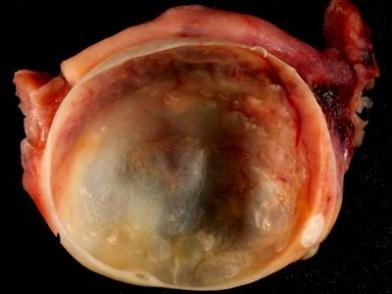 How does a cyst occur? What is a yellow body cyst?