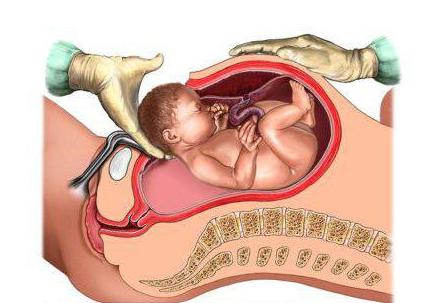 second caesarean section when put in hospital